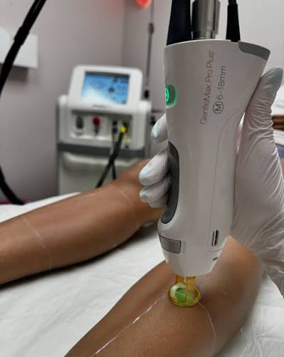 LASER HAIR REMOVAL & FOLLICULITIS