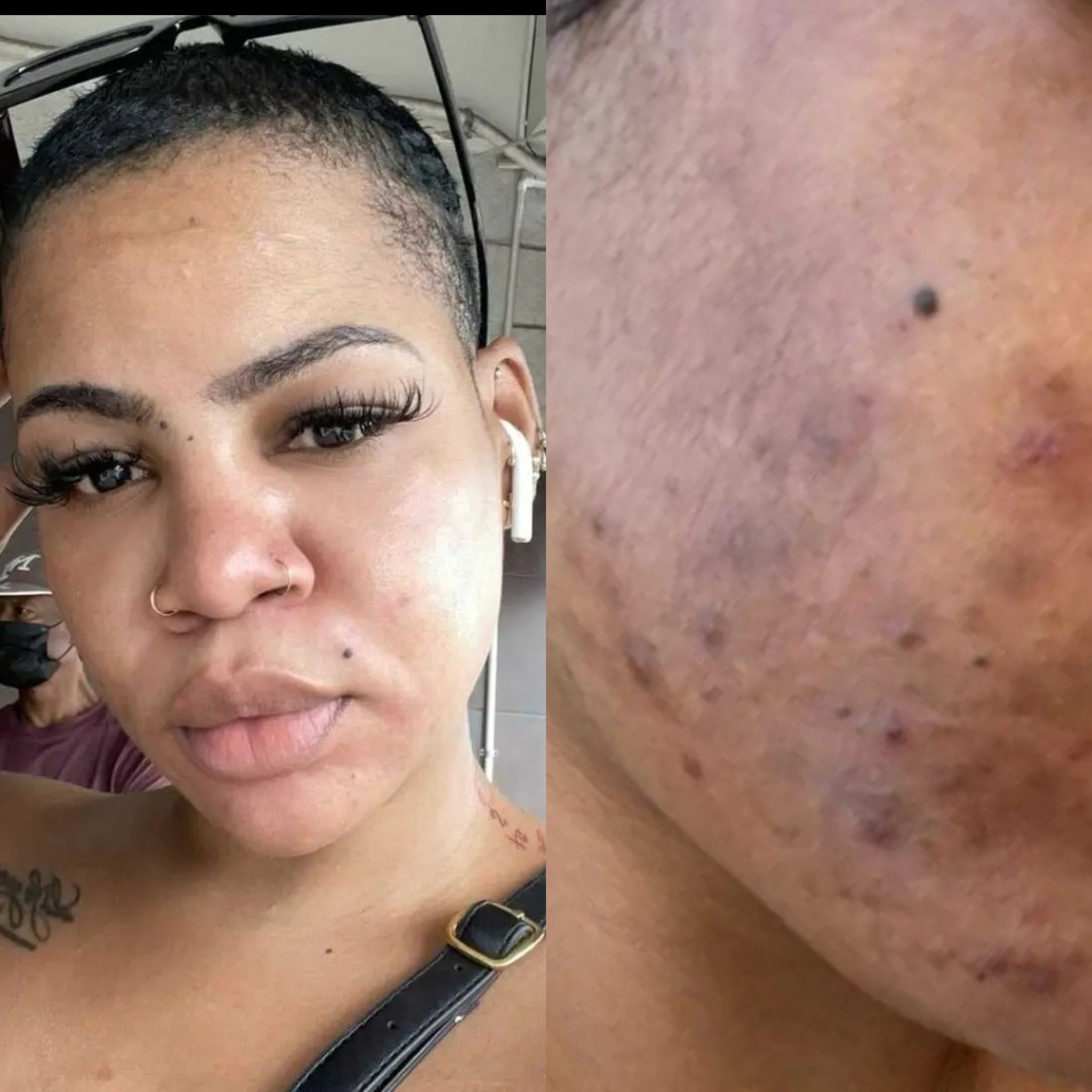 ACNE / DARK SPOTS - 1